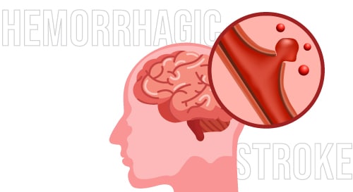 เส้นเลือดในสมองแตก สาเหตุ อาการ และวิธีการรักษา